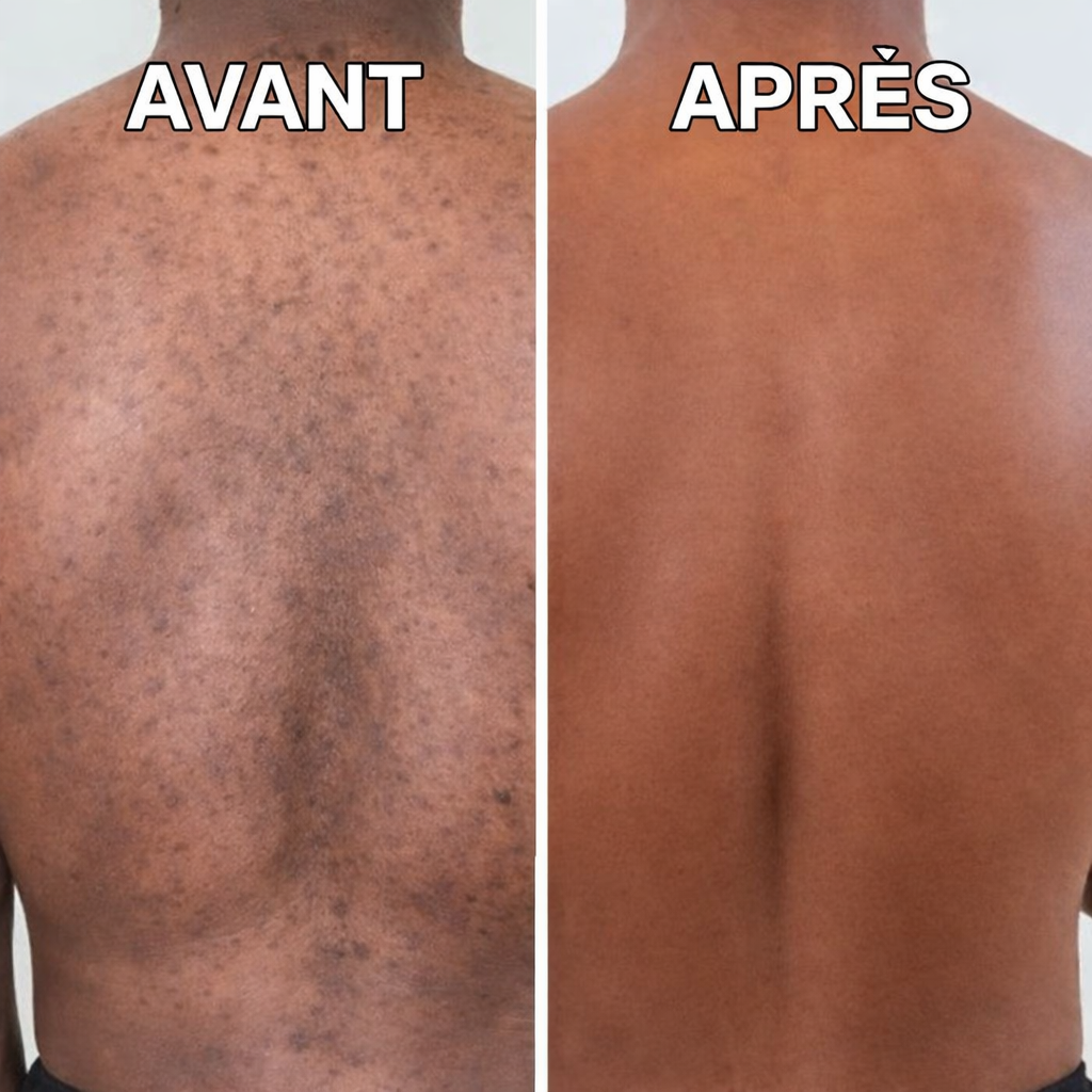 Crème Correctrice Anti-Taches Corps  (Hyperpigmentation - Tous types de Peaux )