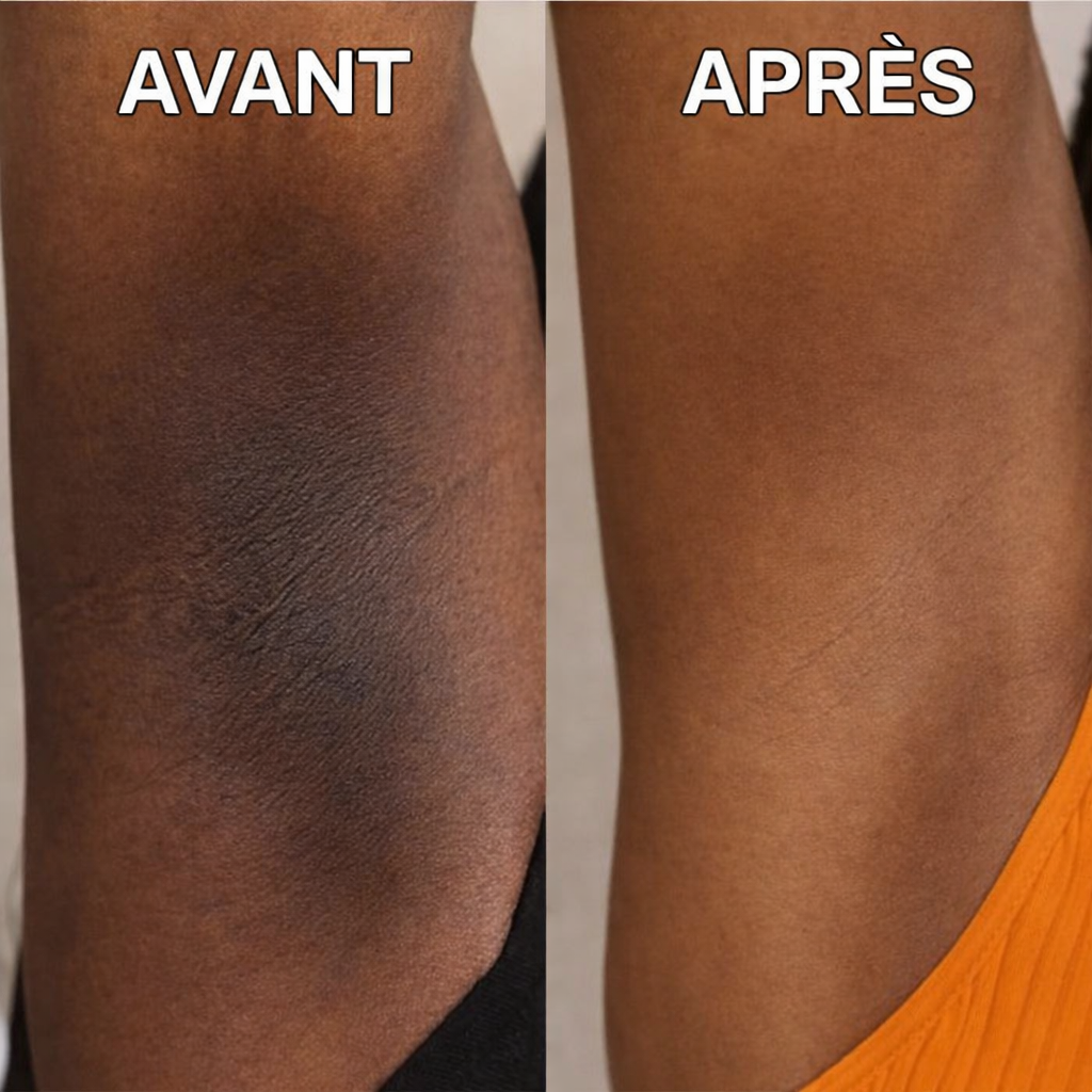 Crème Correctrice Anti-Taches Corps  (Hyperpigmentation - Tous types de Peaux )