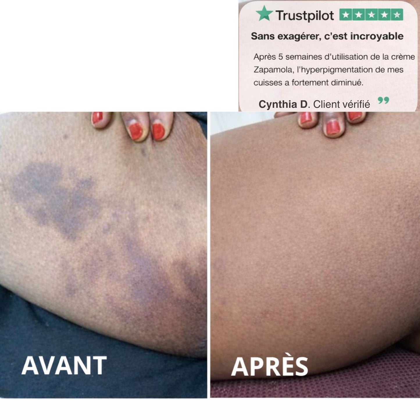 Crème Correctrice Anti-Taches Corps  (Hyperpigmentation - Tous types de Peaux )
