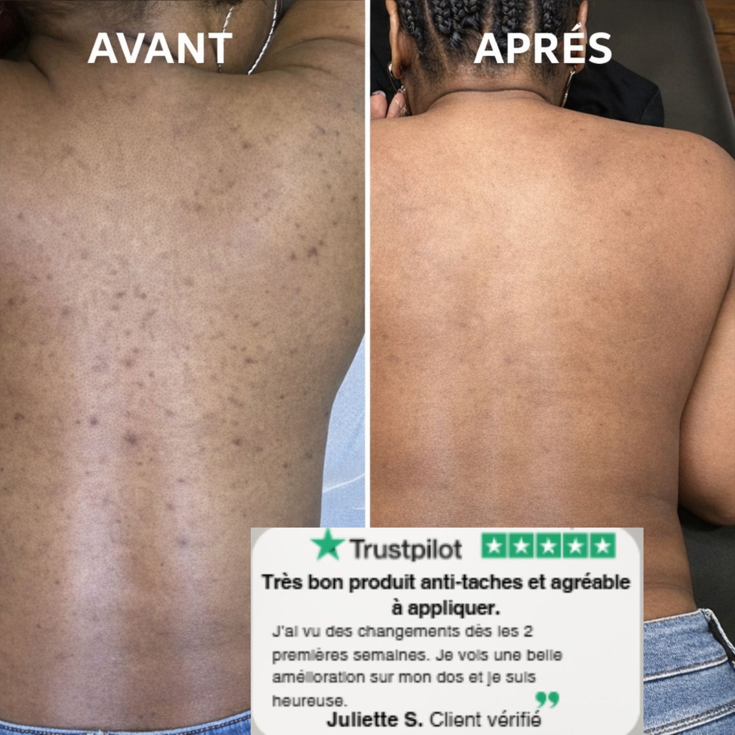 Crème Correctrice Anti-Taches Corps  (Hyperpigmentation - Tous types de Peaux )