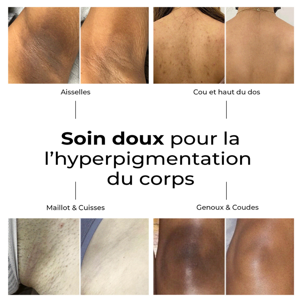 Crème Correctrice Anti-Taches Corps  (Hyperpigmentation - Tous types de Peaux )